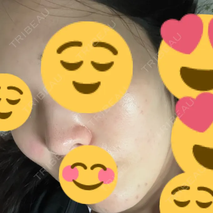 イオン導入 / エレクトロポレーション / 光治療（フォトフェイシャルなど） メディアージュクリニック 大阪梅田院 DAY 10 メイン用