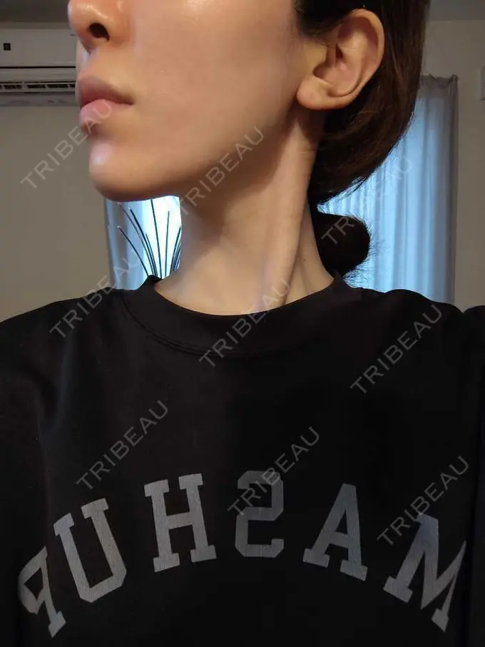 ボトックス（エラ・小顔） / ボトックス（肩） / ボトックス（眉間） / ボトックス（首） Natural Skin Clinic 自由ヶ丘院 DAY 4 メイン用