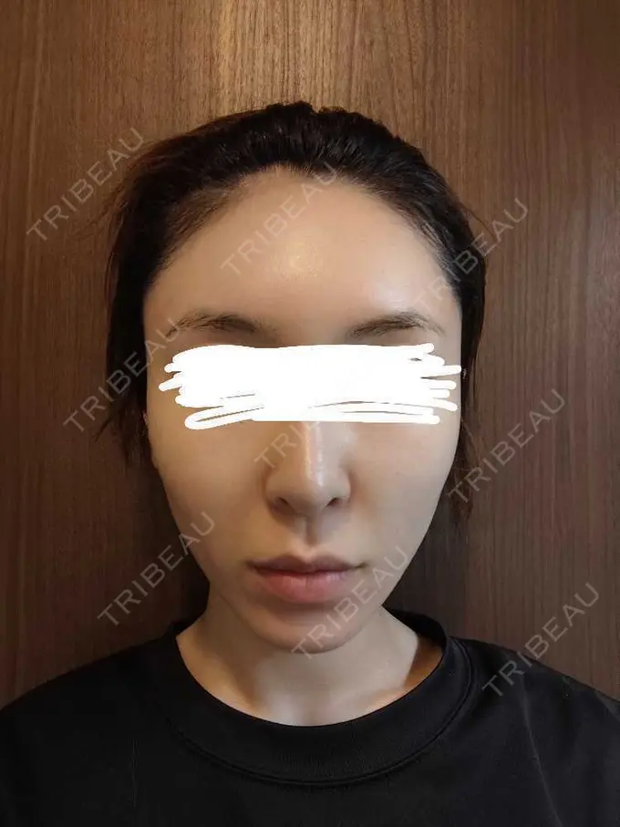 ボトックス（エラ・小顔） / ボトックス（肩） / ボトックス（眉間） / ボトックス（首） Natural Skin Clinic 自由ヶ丘院 DAY 4 メイン用