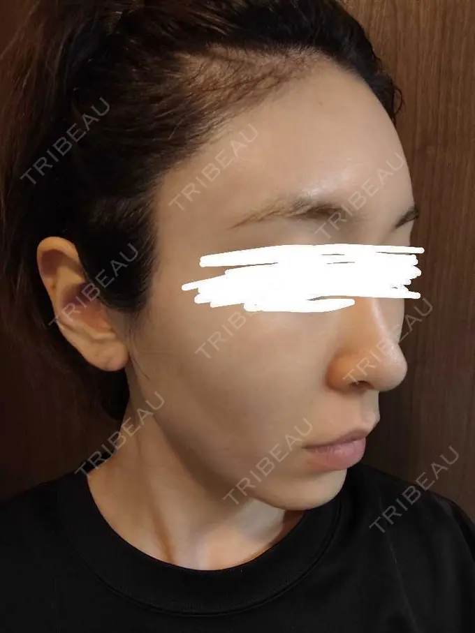 ボトックス（エラ・小顔） / ボトックス（肩） / ボトックス（眉間） / ボトックス（首） Natural Skin Clinic 自由ヶ丘院 DAY 4 メイン用