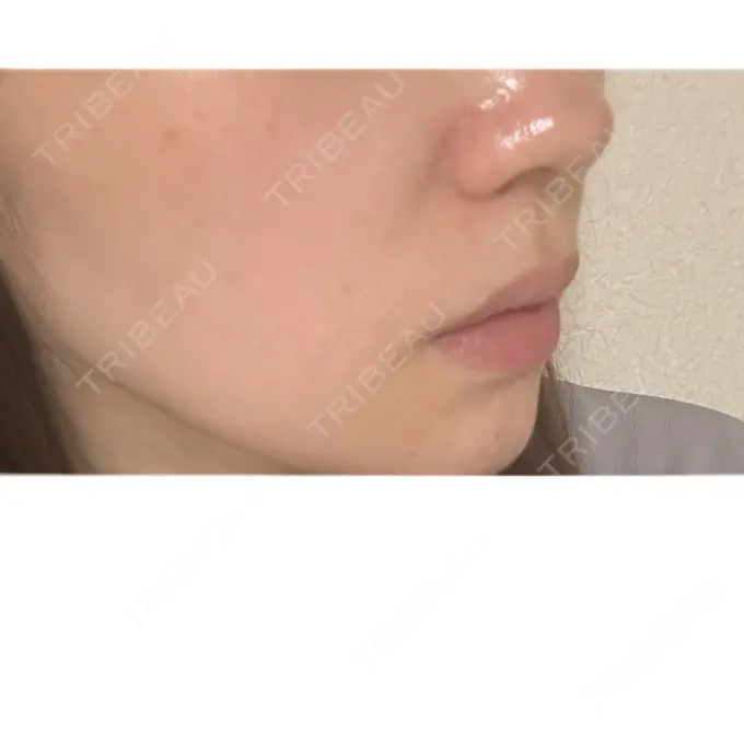 ニードルRF（ポテンツァなど） / アグネス 日本ウェルネス再生クリニック DAY 44 メイン用