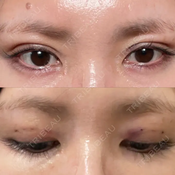 二重埋没 / ヒアルロン酸注入（涙袋） ASTRA BEAUTY CLINIC DAY 0 メイン用