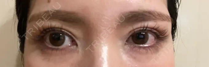 二重埋没 / ヒアルロン酸注入（涙袋） ASTRA BEAUTY CLINIC AFTER メイン用