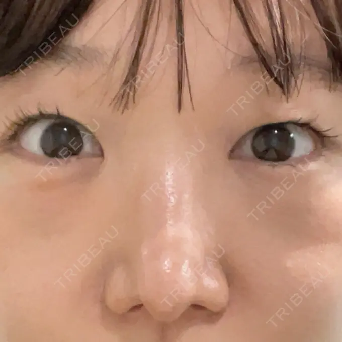 下まぶたの脂肪取り / ヒアルロン酸注入（鼻翼基部） ネビュラクリニック 東京錦糸町院 DAY 3 メイン用