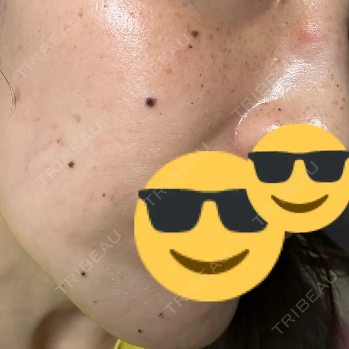 ルメッカ L‘amour clinic Tokyo【ラムールクリニック東京】 DAY 4 メイン用