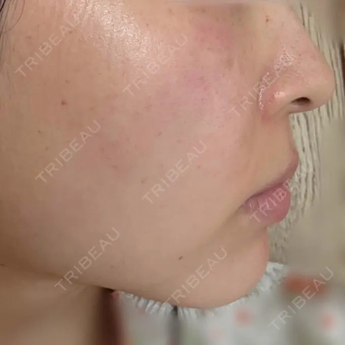 肌育注射（ジュベルックなど） 城本クリニック 姫路院 DAY 3 メイン用