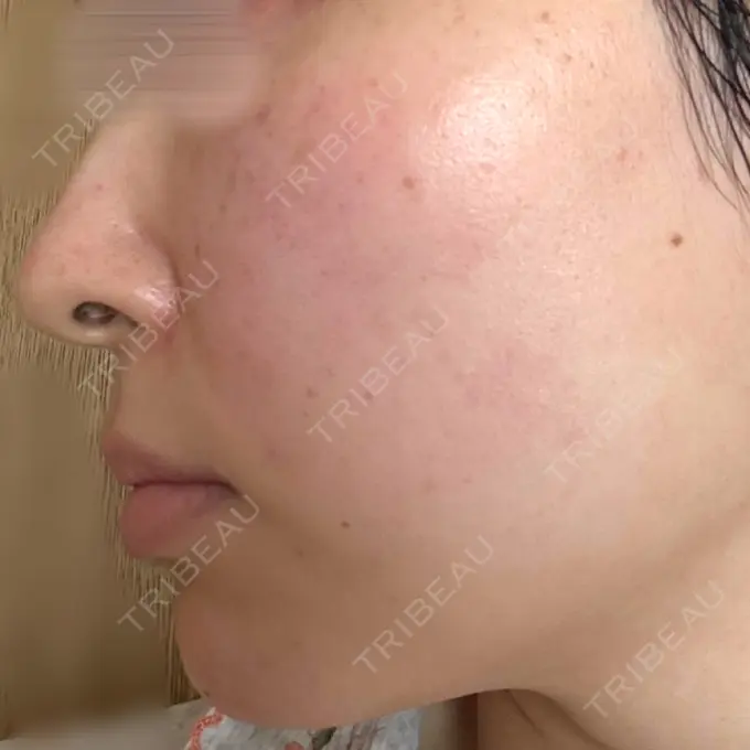 肌育注射（ジュベルックなど） 城本クリニック 姫路院 DAY 3 メイン用