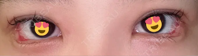 目尻切開 / タレ目形成・グラマラスライン（埋没） LOUIS CLINIC 二子玉川院【ルイクリニック】 DAY 4 メイン用