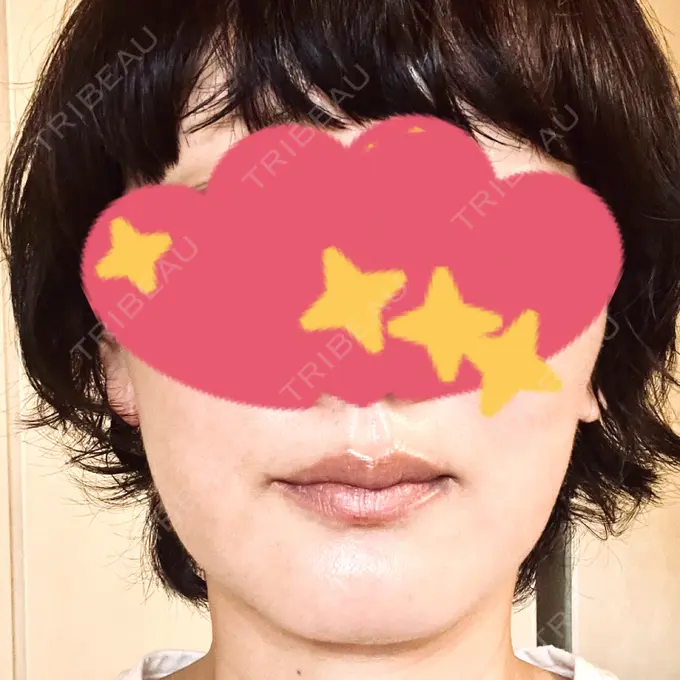 RF（高周波）たるみ治療 / その他（輪郭） DAILY SKIN CLINIC 心斎橋院 DAY 11 メイン用