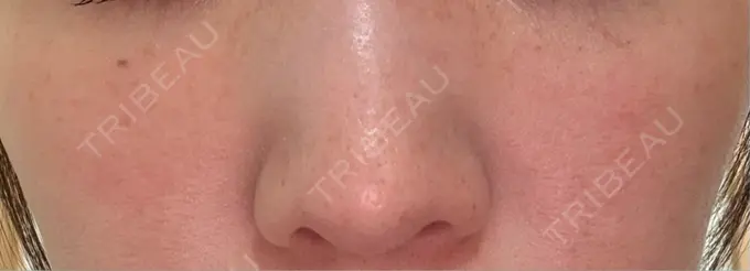 ピーリング（ハリ・ツヤ） / ルメッカ ルラ美容クリニック 仙台院 / ルラスキンクリニック 仙台院 DAY 1 メイン用