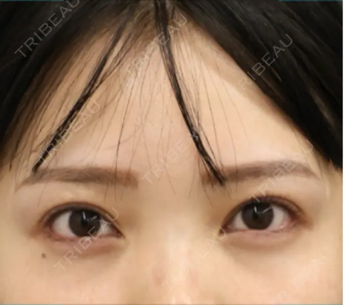 クマ治療 BELLMONA CLINIC AFTER メイン用