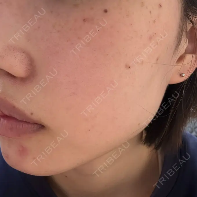 イオン導入 / ルメッカ ルラ美容クリニック 池袋院 AFTER メイン用