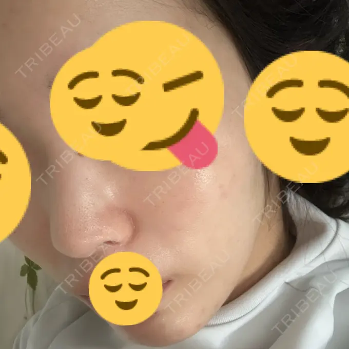 イオン導入 / エレクトロポレーション / 光治療（フォトフェイシャルなど） メディアージュクリニック 大阪梅田院 DAY 11 メイン用