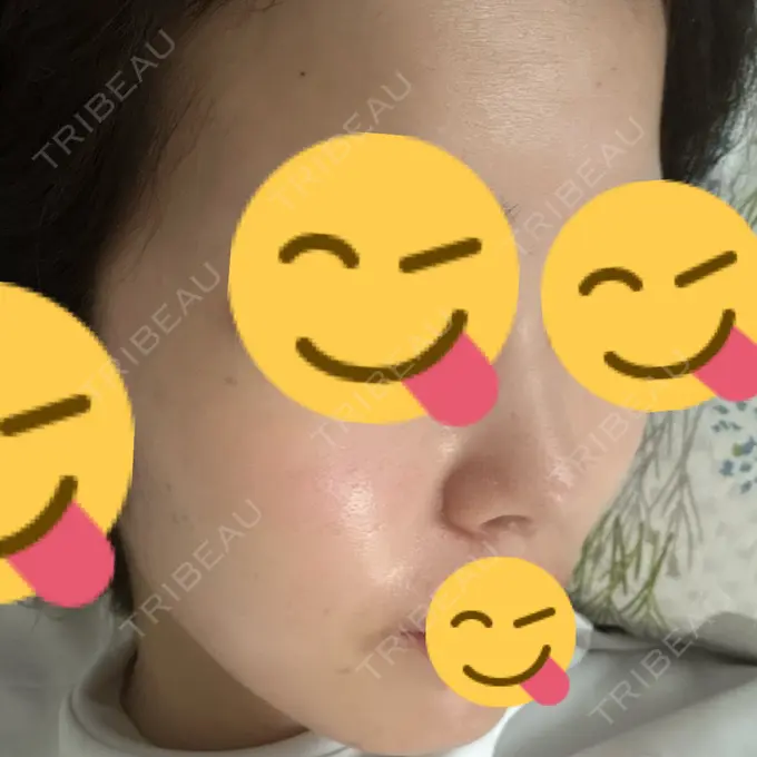 イオン導入 / エレクトロポレーション / 光治療（フォトフェイシャルなど） メディアージュクリニック 大阪梅田院 DAY 11 メイン用