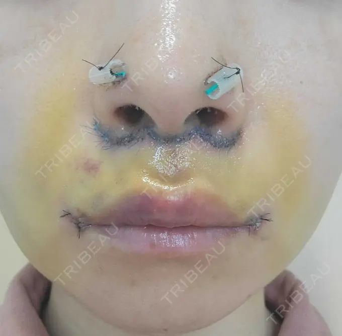 人中短縮 / 鼻孔縁下降 / 口角挙上 新宿ラクル美容外科クリニック 新宿院 DAY 5 メイン用