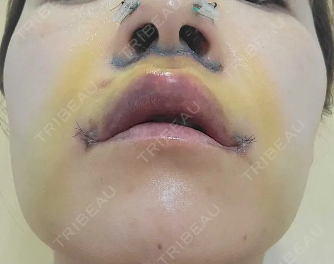人中短縮 / 鼻孔縁下降 / 口角挙上 新宿ラクル美容外科クリニック 新宿院 DAY 5 メイン用