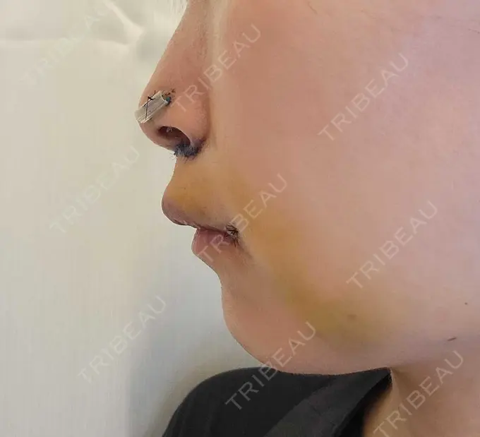 人中短縮 / 鼻孔縁下降 / 口角挙上 新宿ラクル美容外科クリニック 新宿院 DAY 6 メイン用