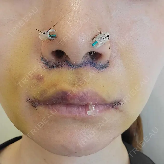 人中短縮 / 鼻孔縁下降 / 口角挙上 新宿ラクル美容外科クリニック 新宿院 DAY 6 メイン用