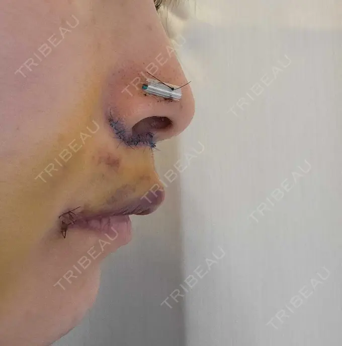 人中短縮 / 鼻孔縁下降 / 口角挙上 新宿ラクル美容外科クリニック 新宿院 DAY 6 メイン用