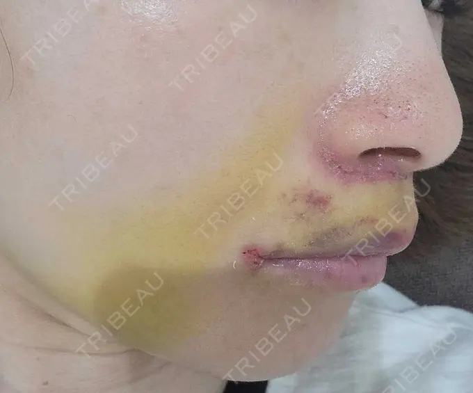 人中短縮 / 鼻孔縁下降 / 口角挙上 新宿ラクル美容外科クリニック 新宿院 DAY 7 メイン用