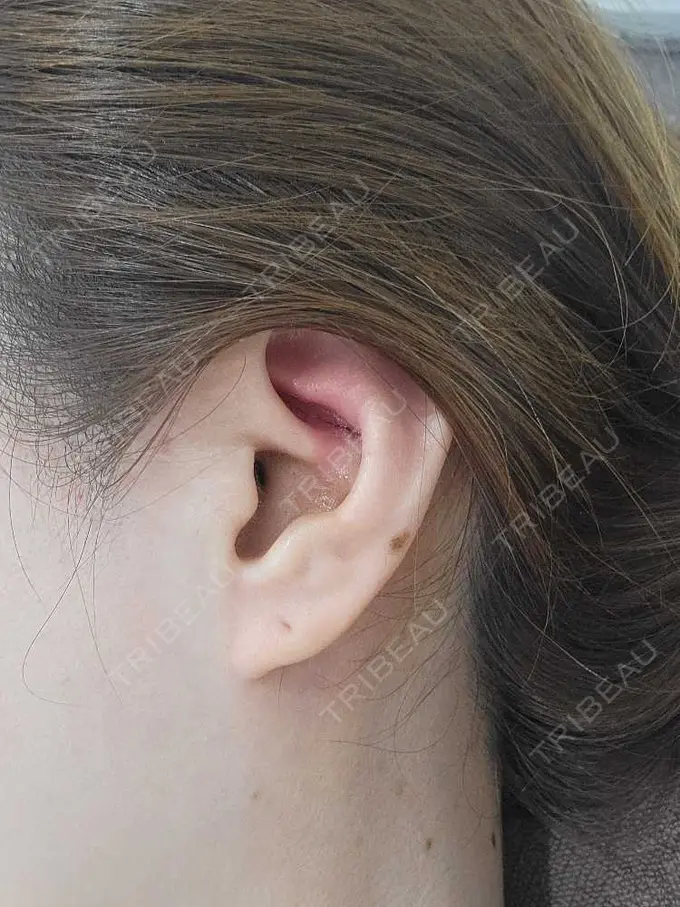 人中短縮 / 鼻孔縁下降 / 口角挙上 新宿ラクル美容外科クリニック 新宿院 DAY 7 メイン用