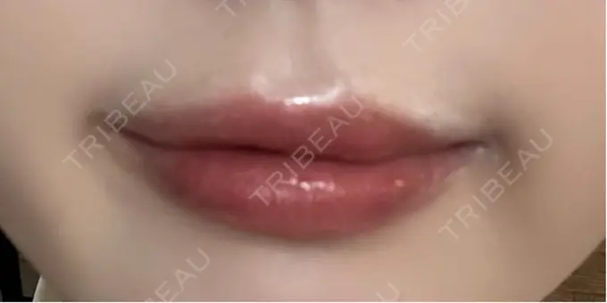 セットバック / ヒアルロン酸注入（唇） / ボトックス（口角） フィラークリニック 大阪梅田院 AFTER メイン用