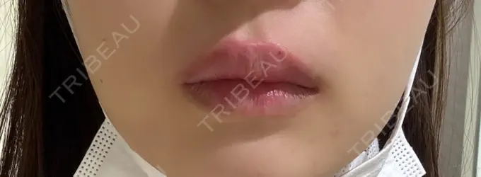 セットバック / ヒアルロン酸注入（唇） / ボトックス（口角） フィラークリニック 大阪梅田院 DAY 0 メイン用