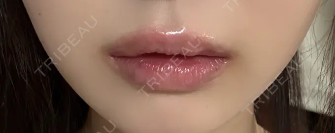 セットバック / ヒアルロン酸注入（唇） / ボトックス（口角） フィラークリニック 大阪梅田院 DAY 1 メイン用