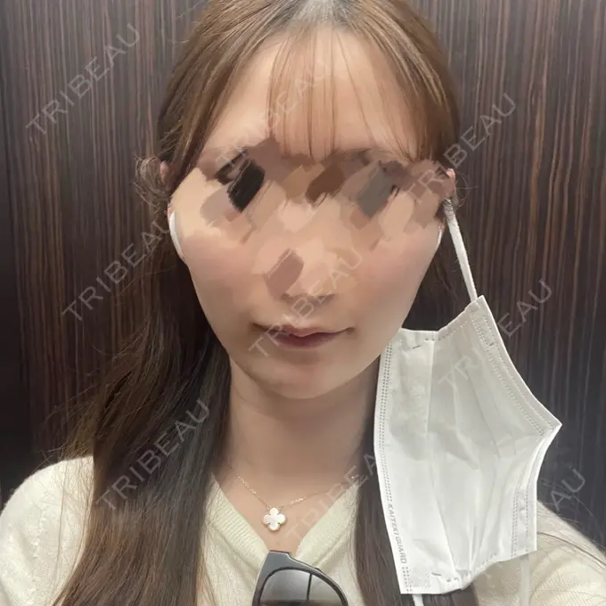 ハイフ（顔） エースクリニック 大阪梅田HEPナビオ院 AFTER メイン用