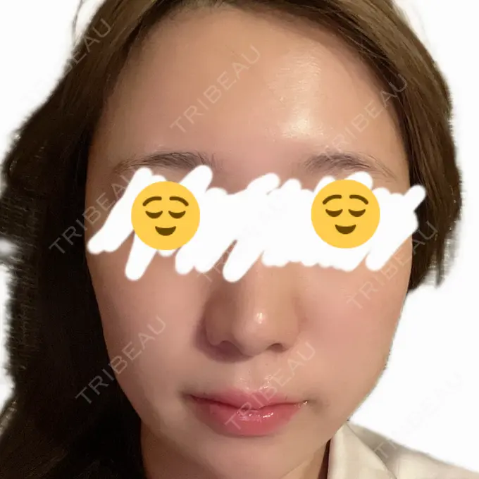 ヒアルロン酸注入（涙袋） / ヒアルロン酸注入（頬） / ヒアルロン酸注入（こめかみ） SUNMELIA SKIN CLINIC AFTER メイン用