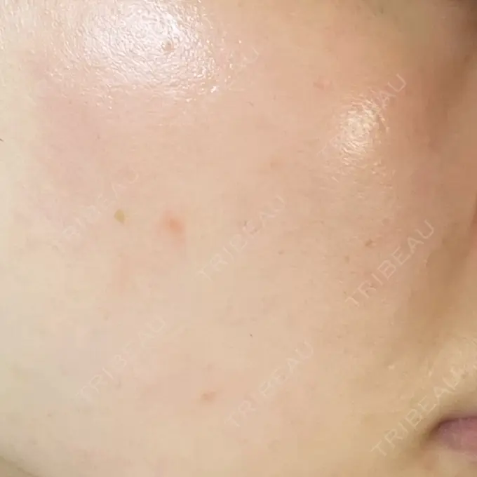 ルビーレーザー AZ BEAUTY CLINIC DAY 8 メイン用