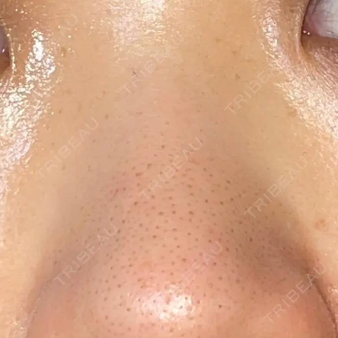 ルビーレーザー AZ BEAUTY CLINIC DAY 8 メイン用