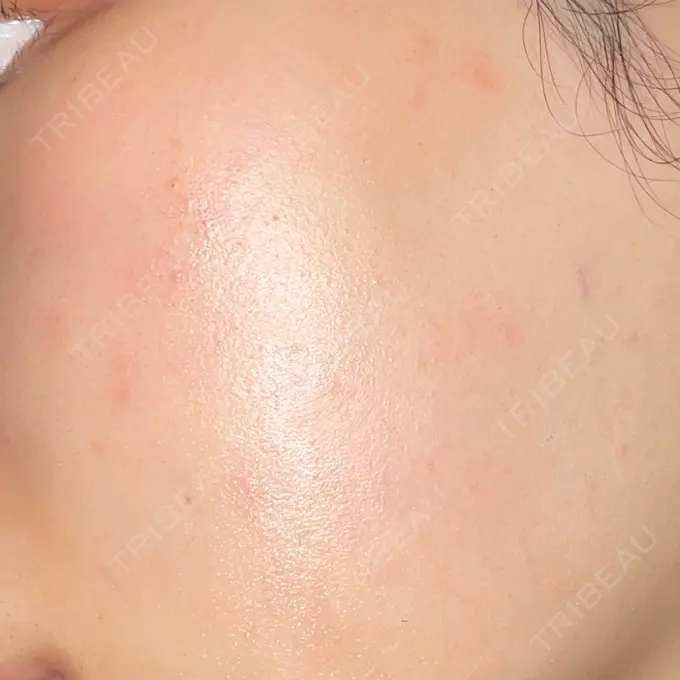 ルビーレーザー AZ BEAUTY CLINIC DAY 8 メイン用