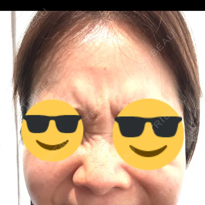 シワ取りボトックス / ボトックス（眉間） / ボトックス（額） / その他（肌） 湘南美容クリニック 大阪四ツ橋院 DAY 0 メイン用