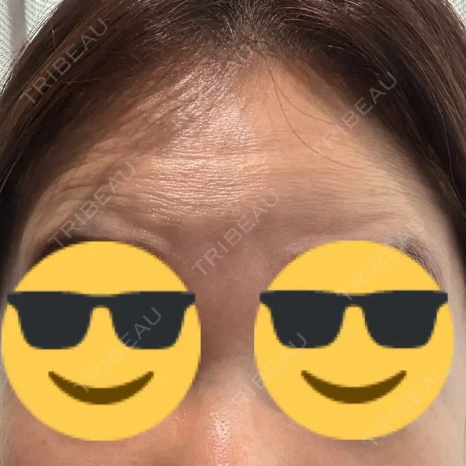 シワ取りボトックス / ボトックス（眉間） / ボトックス（額） / その他（肌） 湘南美容クリニック 大阪四ツ橋院 DAY 0 メイン用