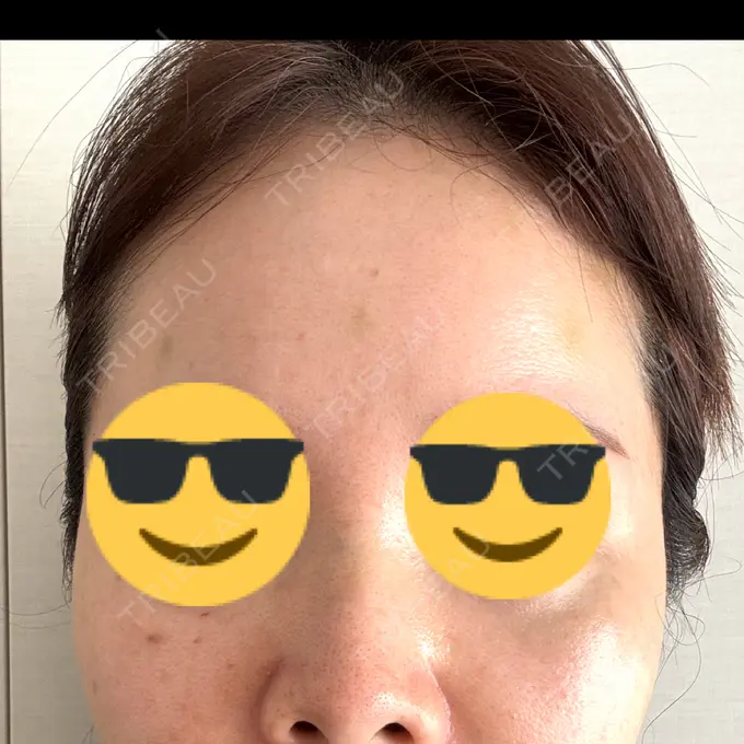 シワ取りボトックス / ボトックス（眉間） / ボトックス（額） / その他（肌） 湘南美容クリニック 大阪四ツ橋院 AFTER メイン用