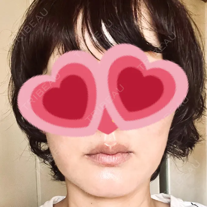 RF（高周波）たるみ治療 / その他（輪郭） DAILY SKIN CLINIC 心斎橋院 DAY 12 メイン用