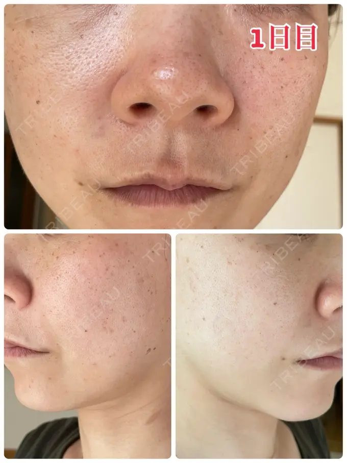 ピーリング（ハリ・ツヤ） / ルメッカ ルラ美容クリニック 名古屋本院 DAY 1 メイン用