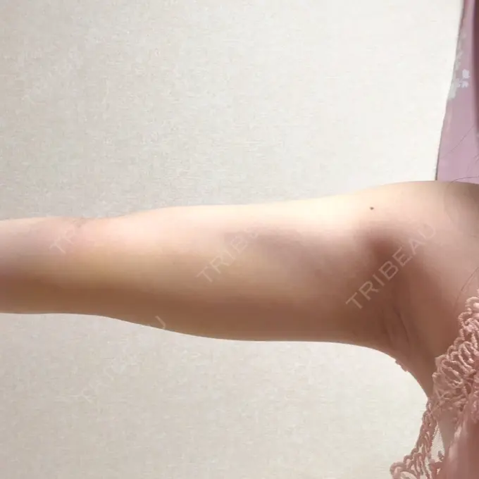 脂肪吸引（二の腕） / 脂肪吸引（肩） THE CLINIC（ザ・クリニック） 福岡院 DAY 7 メイン用