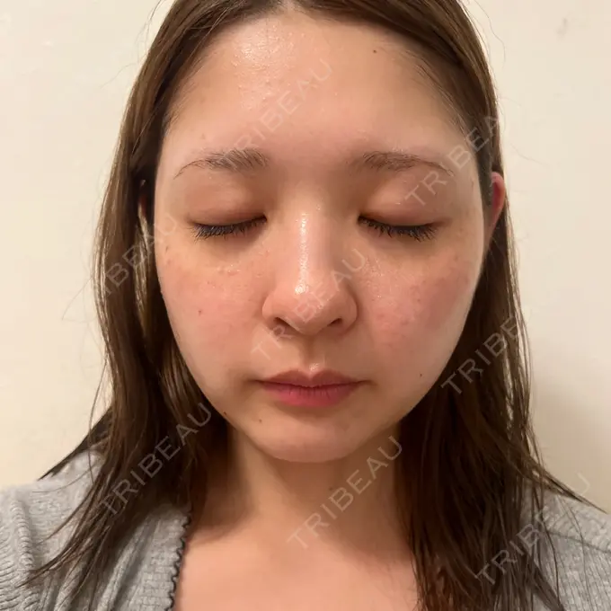 イオン導入 / ルメッカ ルラ美容クリニック 渋谷本院 AFTER メイン用