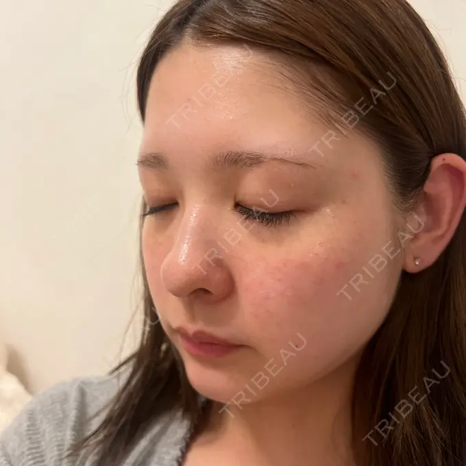 イオン導入 / ルメッカ ルラ美容クリニック 渋谷本院 DAY 1 メイン用