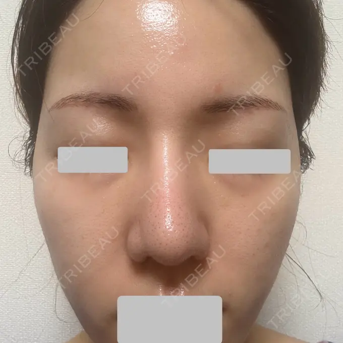 肌育注射（ジュベルックなど） Next Tokyo Clinic DAY 7 メイン用