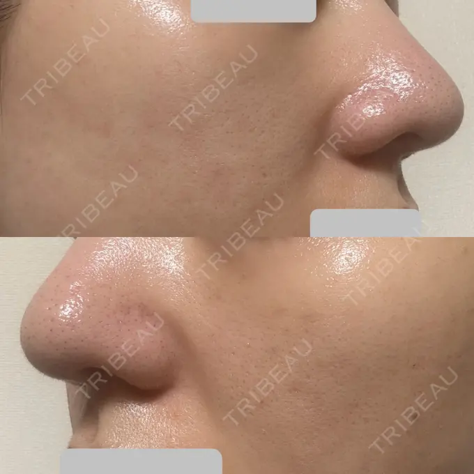 肌育注射（ジュベルックなど） Next Tokyo Clinic DAY 7 メイン用