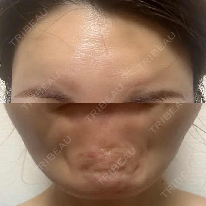 肌育注射（ジュベルックなど） Next Tokyo Clinic DAY 7 メイン用