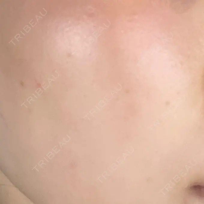 ルビーレーザー AZ BEAUTY CLINIC DAY 10 メイン用