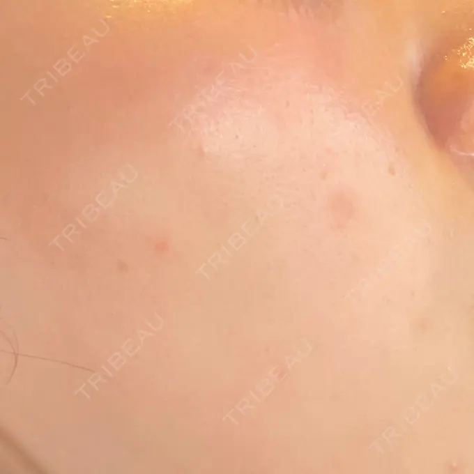 ルビーレーザー AZ BEAUTY CLINIC DAY 10 メイン用