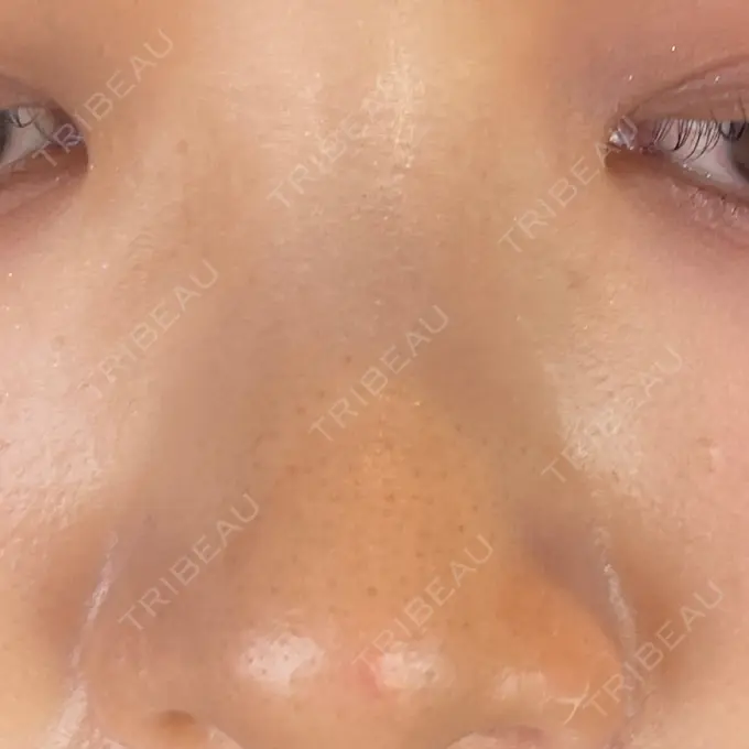 ルビーレーザー AZ BEAUTY CLINIC DAY 10 メイン用