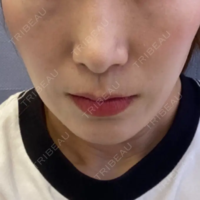 イオン導入 / ピーリング（ハリ・ツヤ） ルラ美容クリニック 名古屋本院 AFTER メイン用