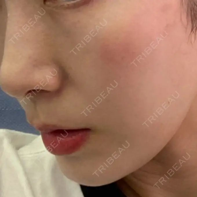 イオン導入 / ピーリング（ハリ・ツヤ） ルラ美容クリニック 名古屋本院 DAY 0 メイン用