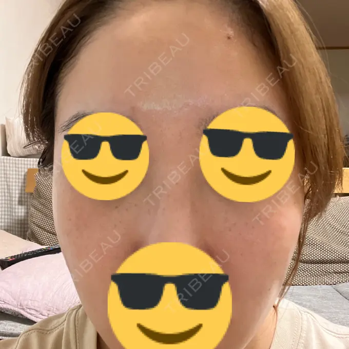 ピーリング（ハリ・ツヤ） / ルメッカ PureMe Skin Clinic（ピュアミースキンクリニック麻布） DAY 4 メイン用